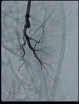 Angiogram image showing vascular branching for an interventional radiology review