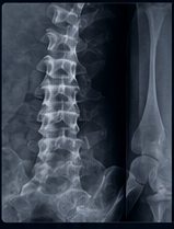 Spine X-ray image for a chiropractic compliance review